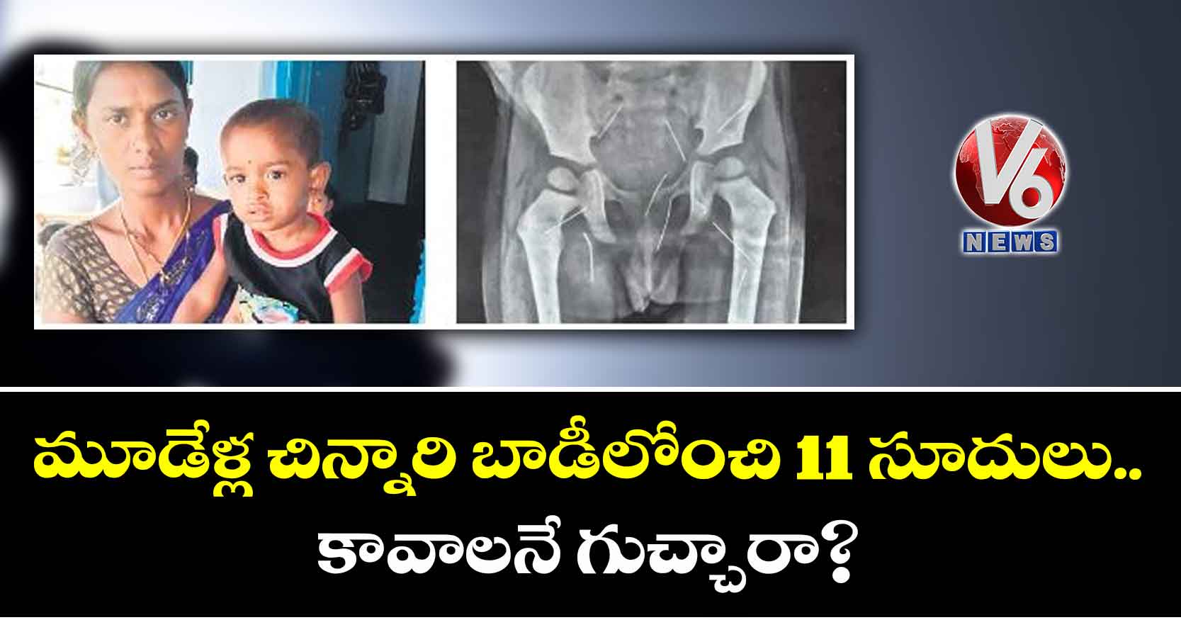మూడేళ్ల చిన్నారి బాడీలోంచి 11 సూదులు..కావాలనే గుచ్చారా?