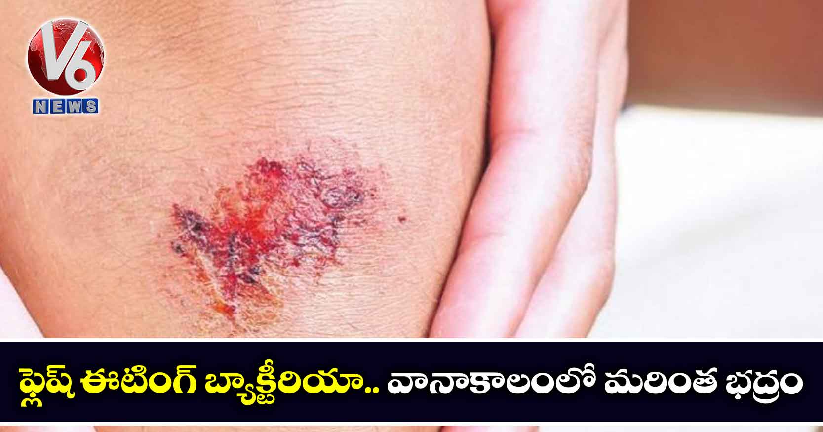 ఫ్లెష్ ఈటింగ్ బ్యాక్టీరియా.. వానాకాలంలో మరింత భద్రం