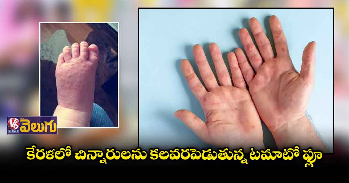 కేరళలో చిన్నారులను కలవరపెడుతున్న టమాటో ఫ్లూ