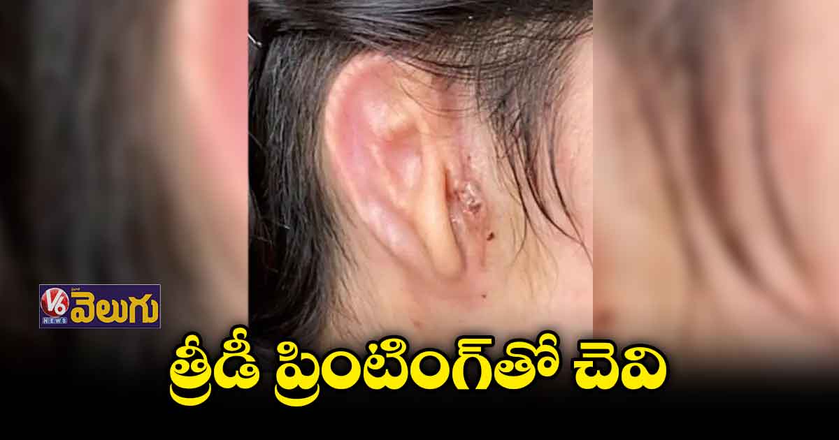 యువతికి త్రీడీ ప్రింటింగ్ చెవి అమర్చిన డాక్టర్లు