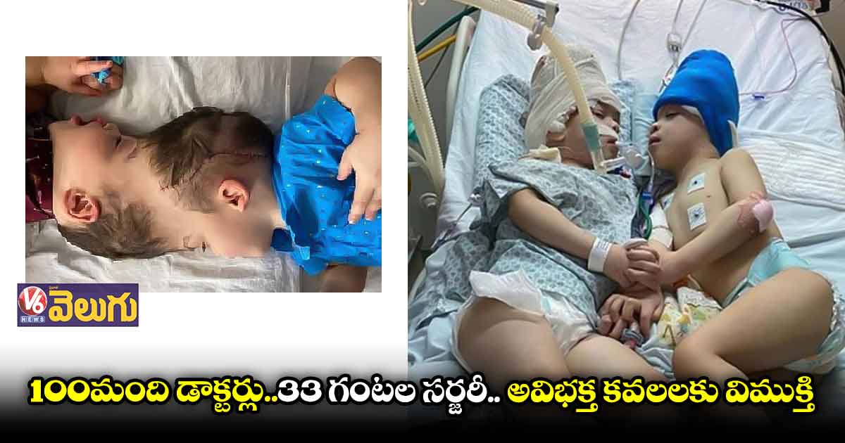 సర్జరీ సక్సెస్... అవిభక్త కవలలకు విముక్తి