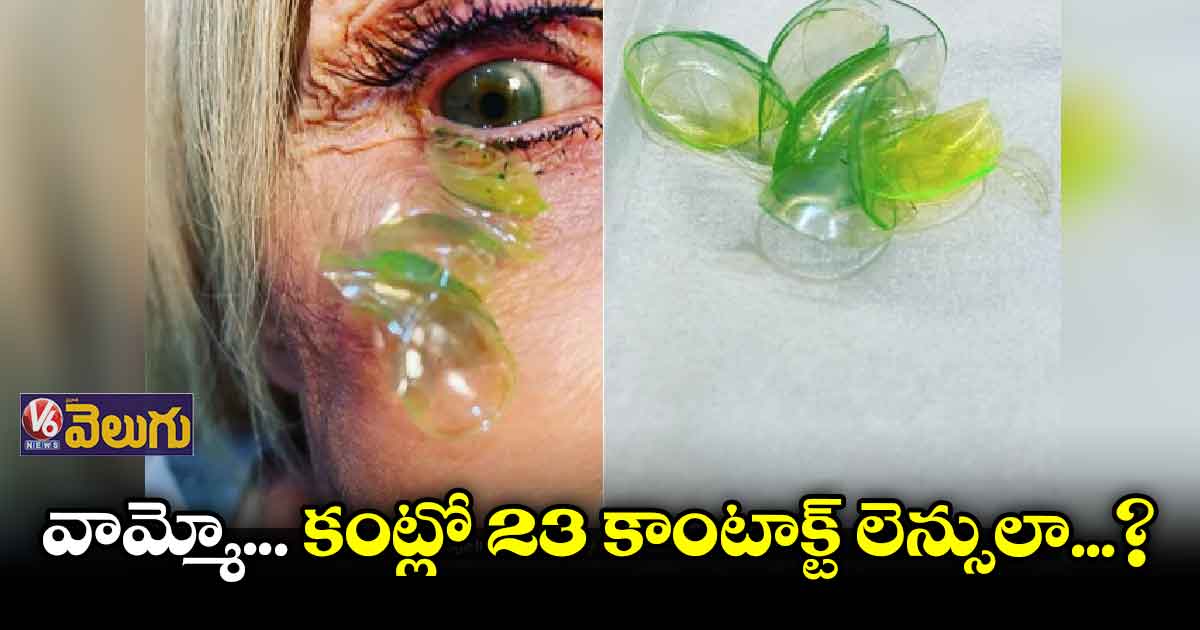 కంటి నుంచి 23 కాంటాక్ట్ లెన్సుల తొలగింపు