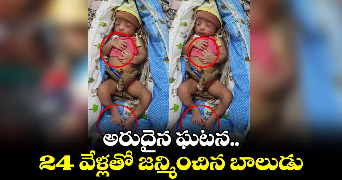 కోరుట్ల ప్రభుత్వాస్పత్రిలో 24 వేళ్లతో శిశువు జననం