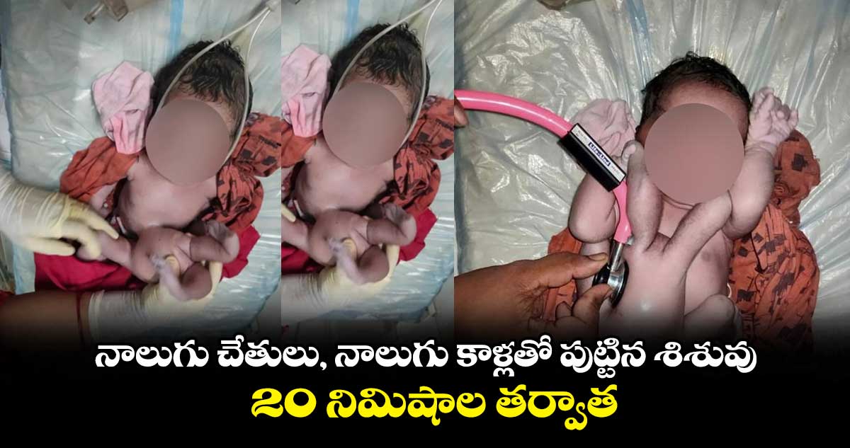 నాలుగు చేతులు, నాలుగు కాళ్లతో పుట్టిన శిశువు.. 20 నిమిషాల తర్వాత