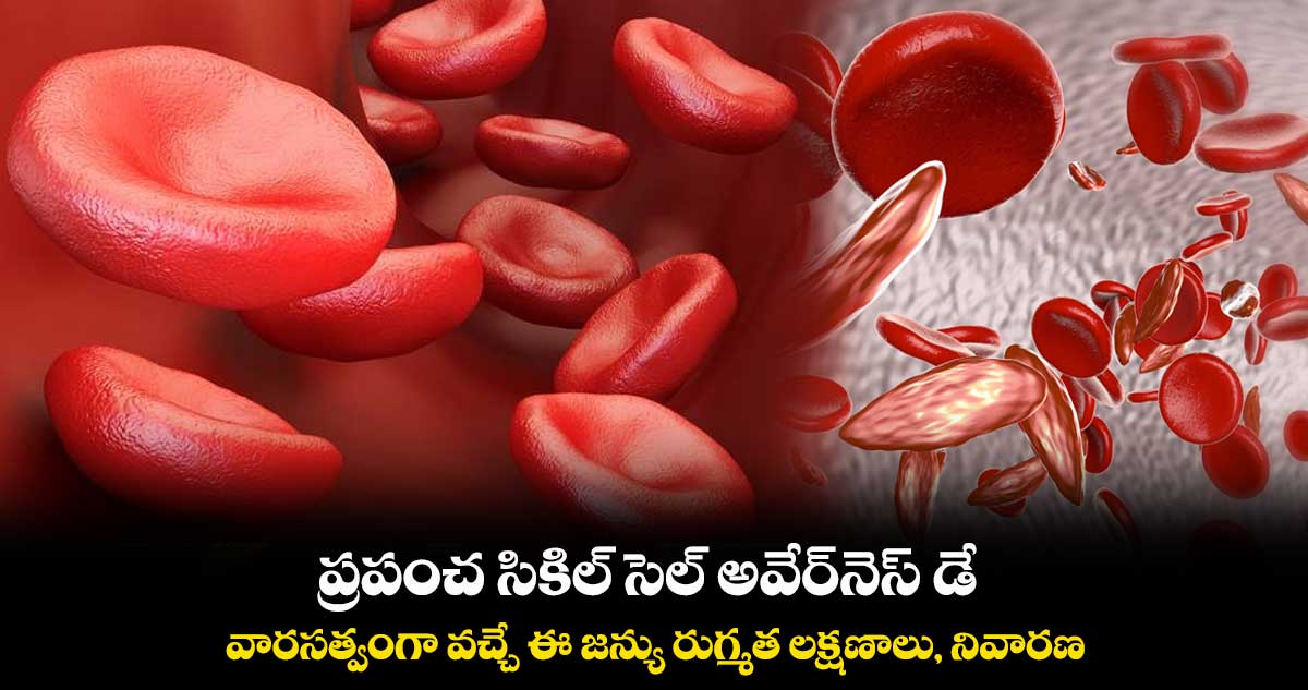 ప్రపంచ సికిల్ సెల్ అవేర్నెస్ డే 2023 : వారసత్వంగా వచ్చే ఈ జన్యు రుగ్మత లక్షణాలు, నివారణ