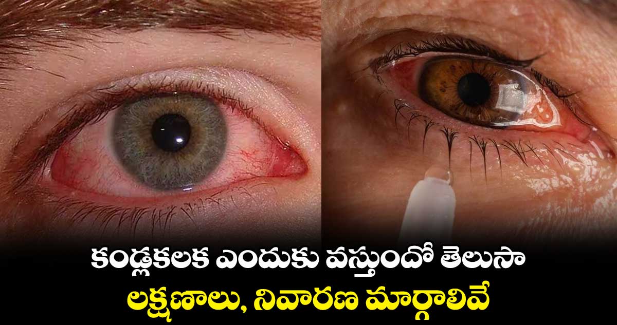 భయపెడుతున్న కండ్లకలక.. లక్షణాలు, నివారణ మార్గాలివే