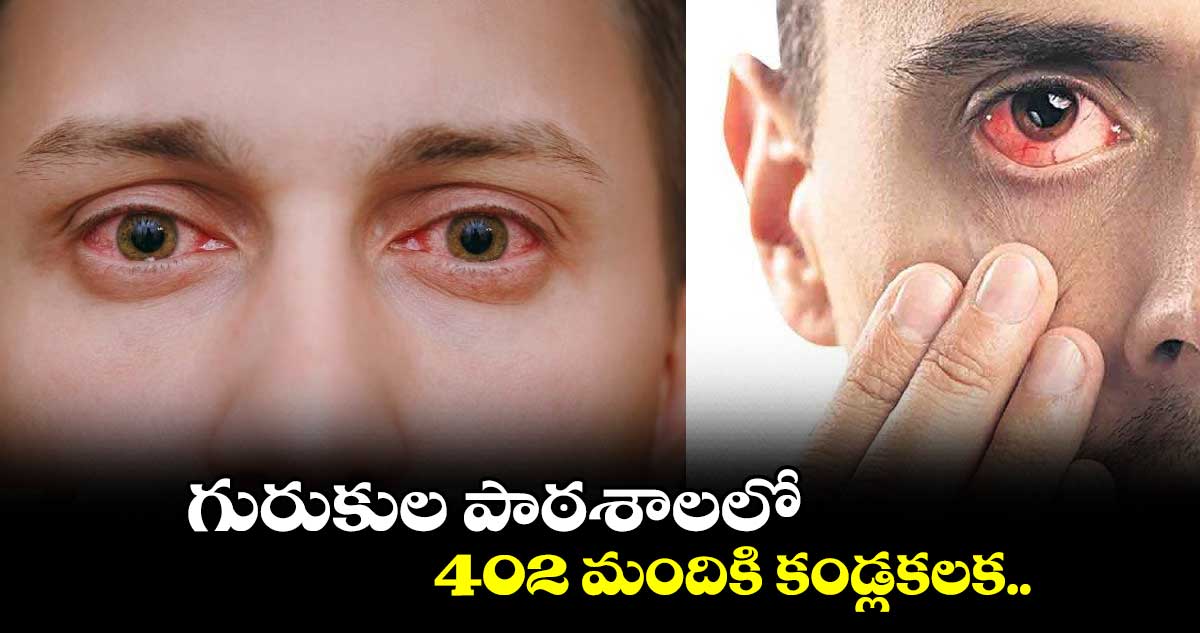 గురుకుల పాఠశాలలో 402 మందికి కండ్లకలక..