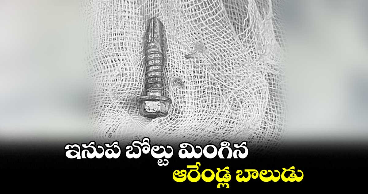 ఇనుప బోల్టు మింగిన ఆరేండ్ల బాలుడు