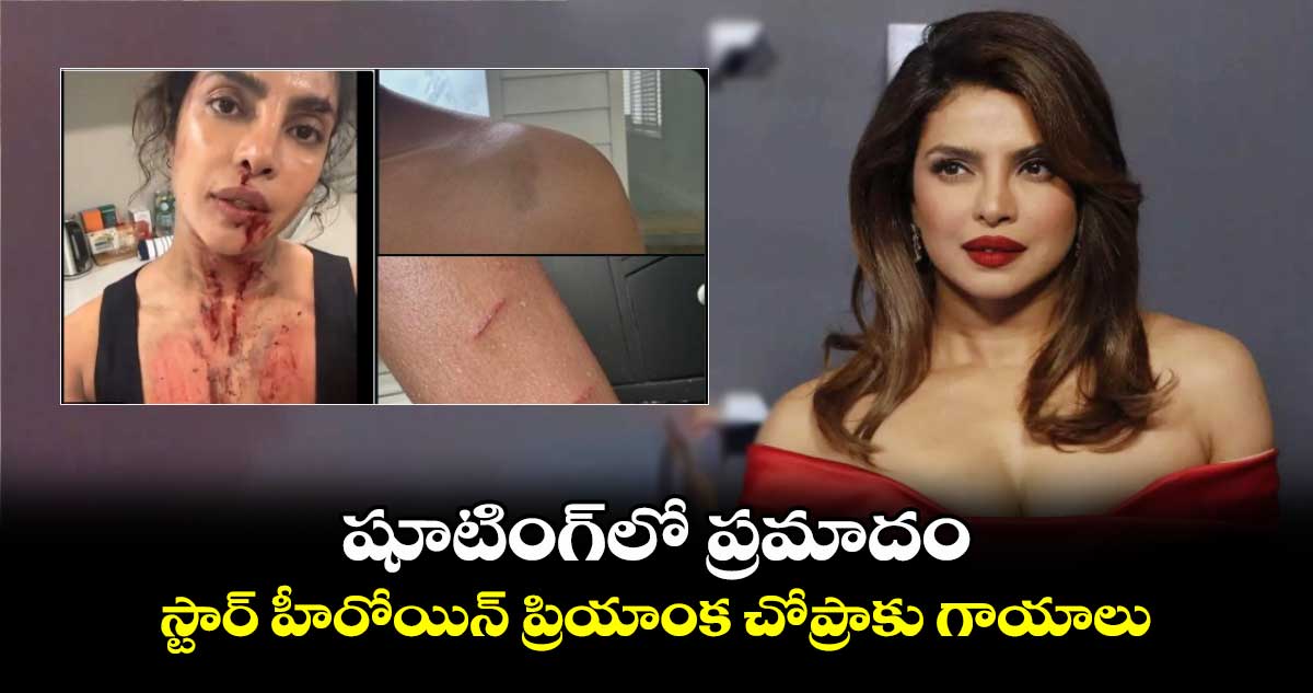 Priyanka Chopra: షూటింగ్లో ప్రమాదం.. స్టార్ హీరోయిన్ ప్రియాంక చోప్రాకు గాయాలు