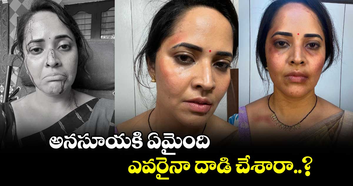 Anasuya Bharadwaj: ముఖంపై గాయాలతో నటి అనసూయ..అసలేమైంది?  