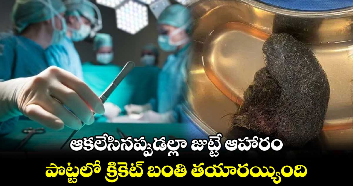 ఆకలేసినప్పుడల్లా జుట్టే ఆహారం.. పొట్టలో క్రికెట్ బంతి తయారయ్యింది