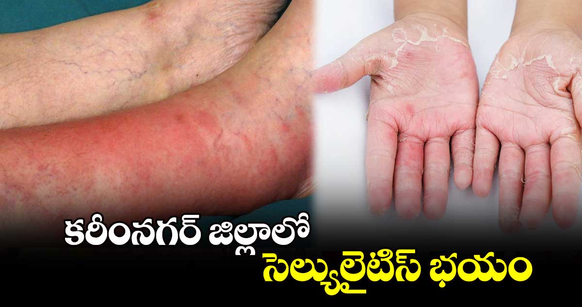 కరీంనగర్​ జిల్లాలో  సెల్యులైటిస్ భయం