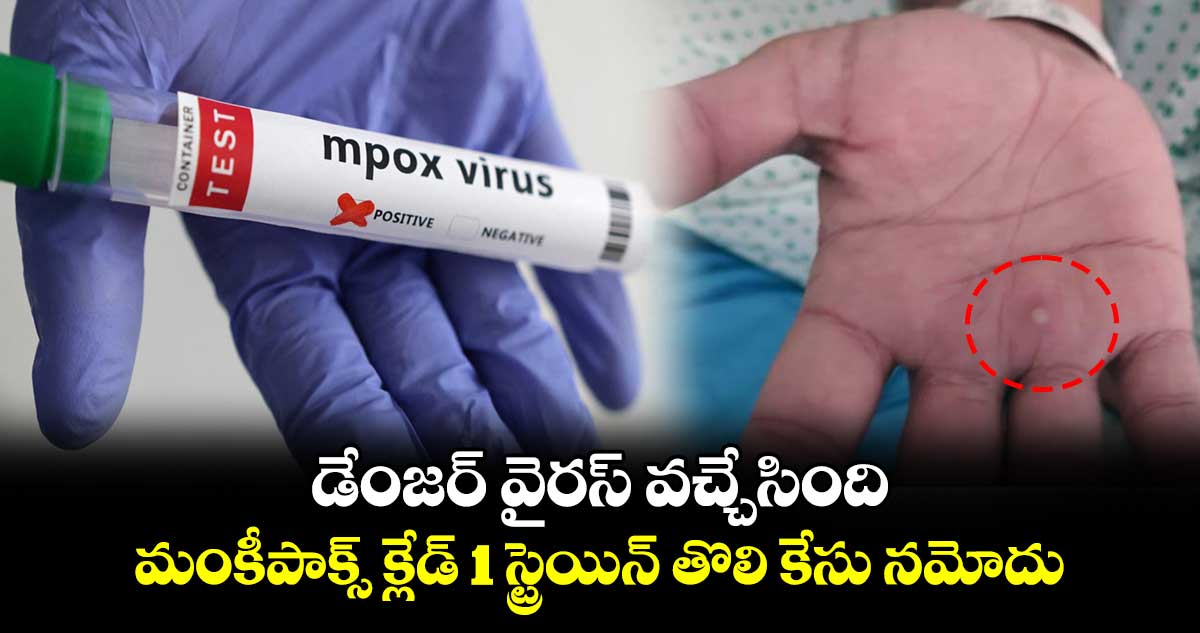 Mpox Clade 1: డేంజర్ వైరస్ వచ్చేసింది.. మంకీపాక్స్ క్లేడ్ 1 స్ట్రెయిన్ తొలి కేసు నమోదు