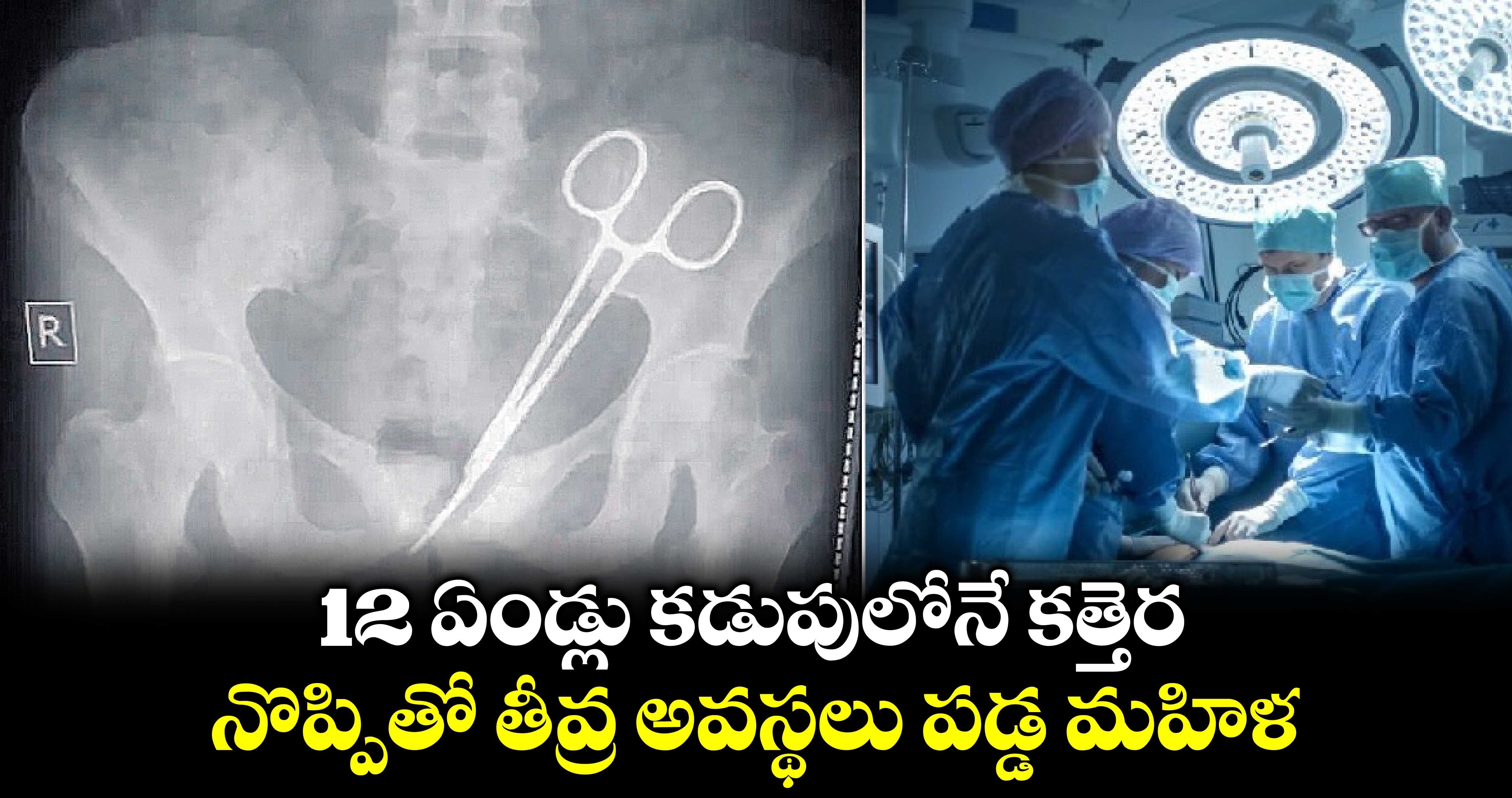 12 ఏండ్లు కడుపులోనే కత్తెర..నొప్పితో తీవ్ర అవస్థలు పడ్డ మహిళ