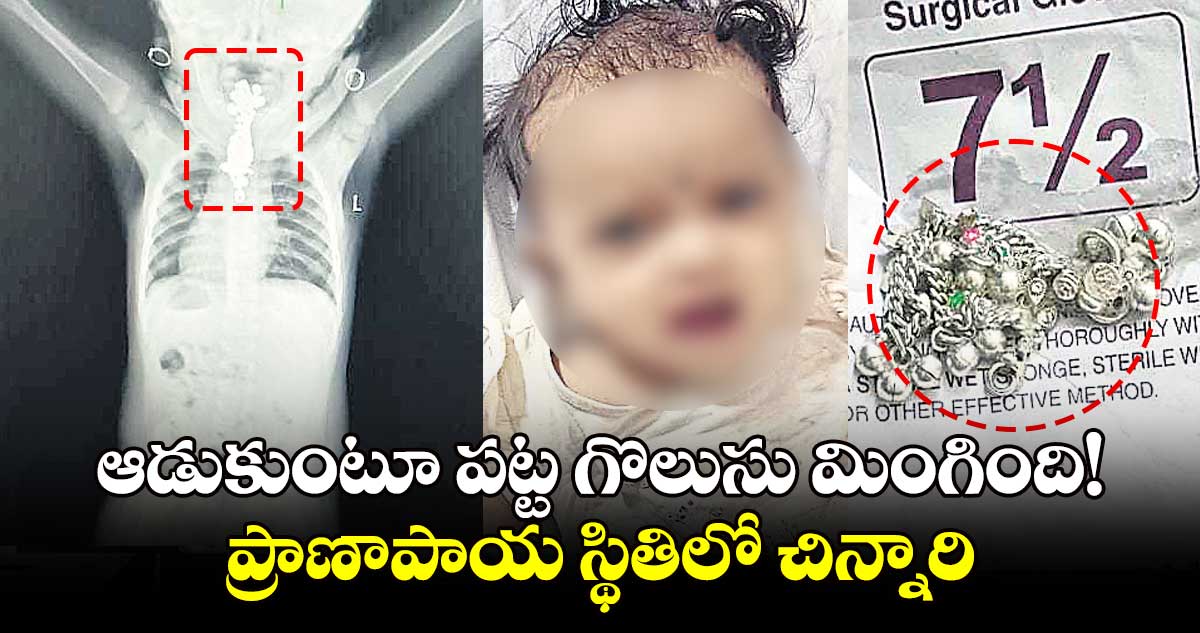 ఆడుకుంటూ పట్ట గొలుసు మింగింది! : ప్రాణాపాయ స్థితిలో చిన్నారి