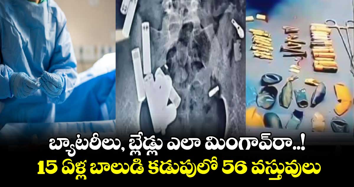 బ్యాటరీలు, బ్లేడ్లు ఎలా మింగావ్‌రా..! 15 ఏళ్ల బాలుడి కడుపులో 56 వస్తువులు