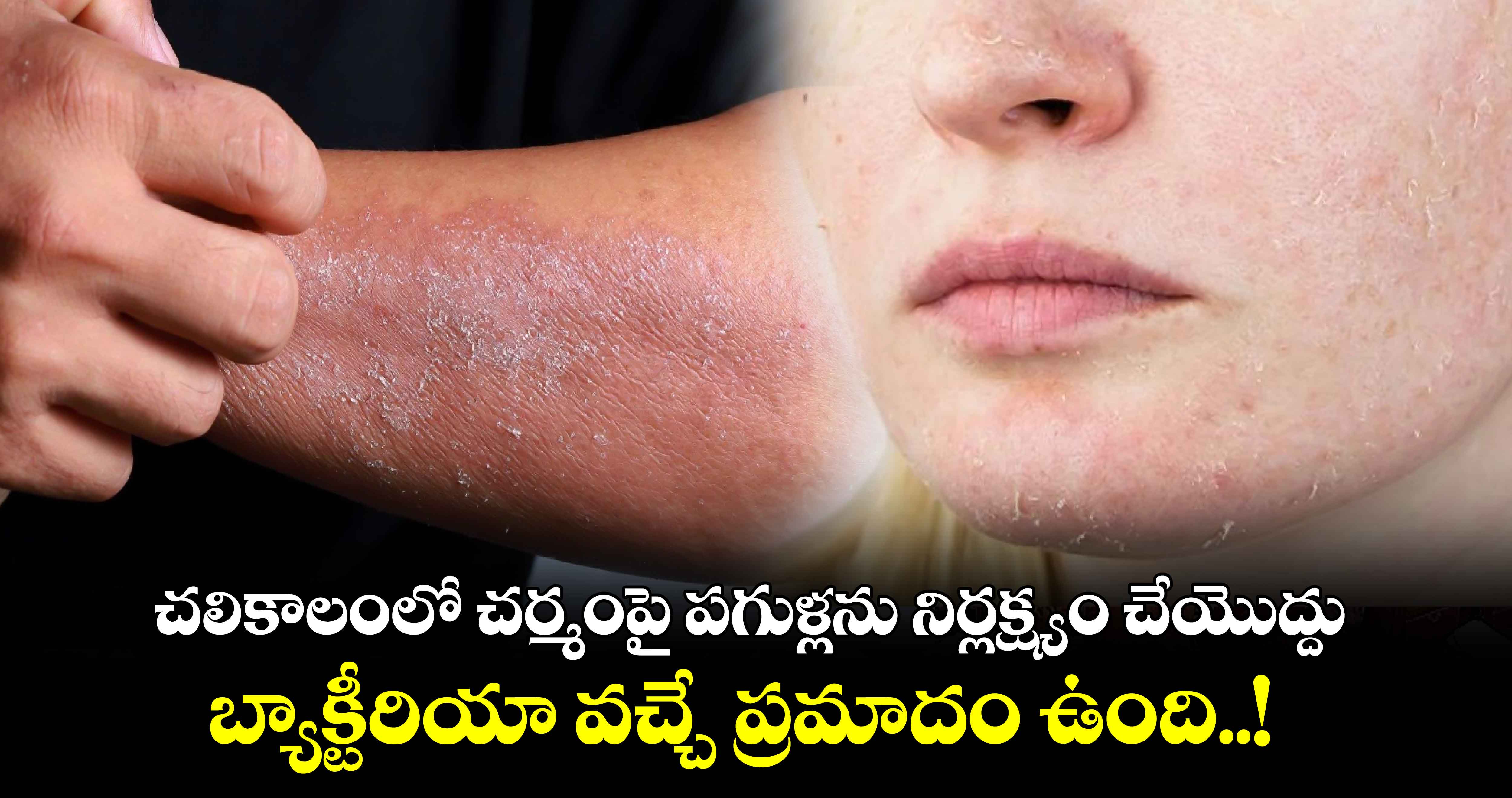 Good Health : చలికాలంలో చర్మంపై పగుళ్లను నిర్లక్ష్యం చేయొద్దు.. బ్యాక్టీరియా వచ్చే ప్రమాదం ఉంది..!