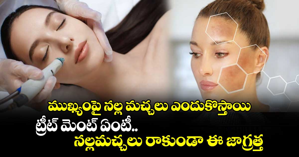 Health Alert : ముఖ్యంపై నల్ల మచ్చలు ఎందుకొస్తాయి.. ట్రీట్ మెంట్ ఏంటీ.. నల్లమచ్చలు రాకుండా ఈ జాగ్రత్తలు.. !