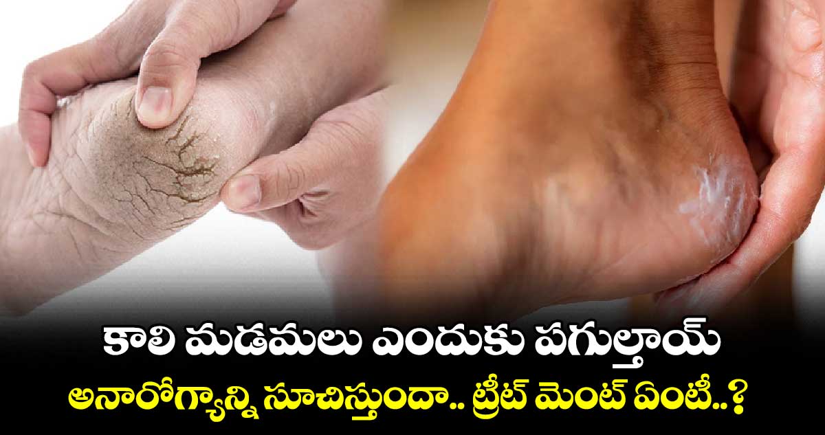 Beauty Tips : కాలి మడమలు ఎందుకు పగుల్తాయ్.. అనారోగ్యాన్ని సూచిస్తుందా.. ట్రీట్ మెంట్ ఏంటీ..?