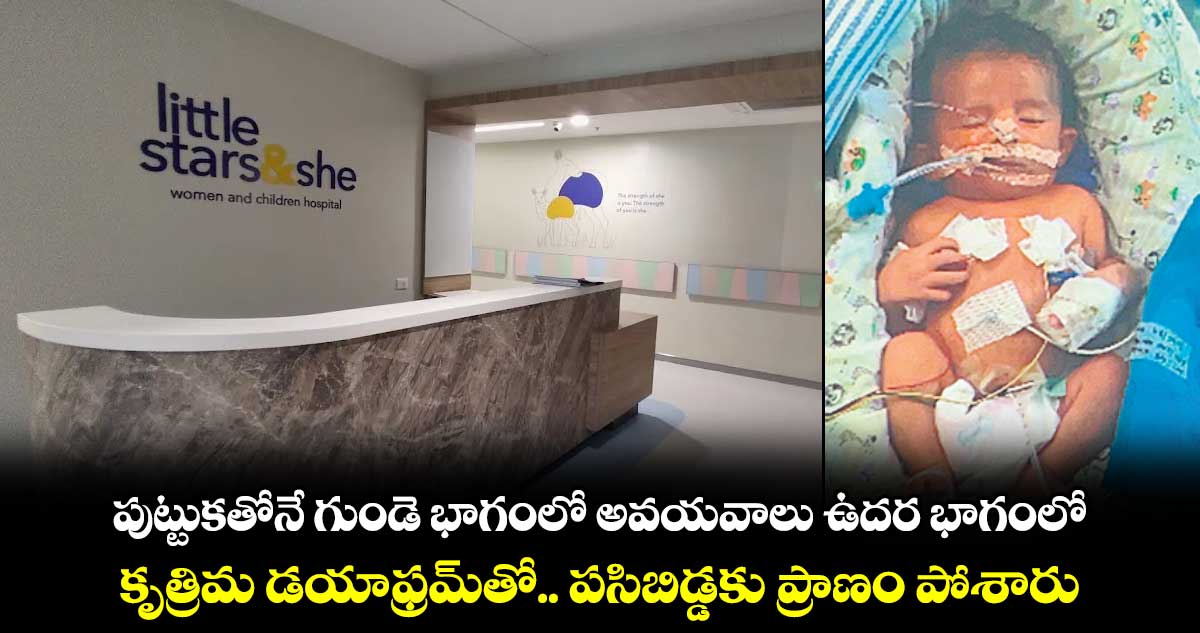 పుట్టుకతోనే గుండె భాగంలో అవయవాలు ఉదర భాగంలో.. కృత్రిమ డయాఫ్రమ్⁬తో.. పసిబిడ్డకు ప్రాణం పోశారు