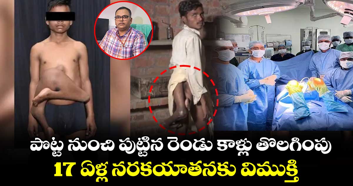 పొట్ట నుంచి పుట్టిన రెండు కాళ్లు తొలగింపు : 17 ఏళ్ల నరకయాతనకు విముక్తి