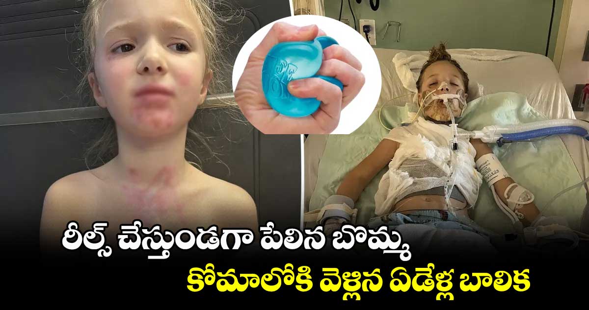 రీల్స్ చేస్తుండగా పేలిన బొమ్మ.. కోమాలోకి వెళ్లిన ఏడేళ్ల బాలిక 