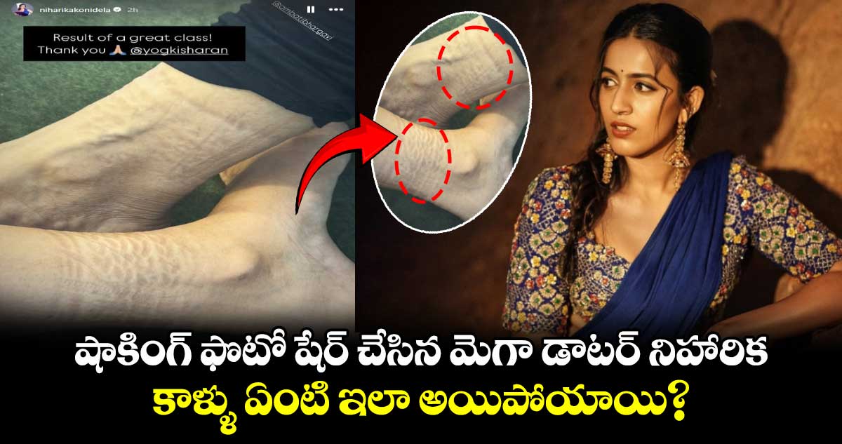 Niharika Konidela: షాకింగ్ ఫొటో షేర్ చేసిన మెగా డాటర్ నిహారిక.. పాదాలు ఏంటి ఇలా అయిపోయాయి?