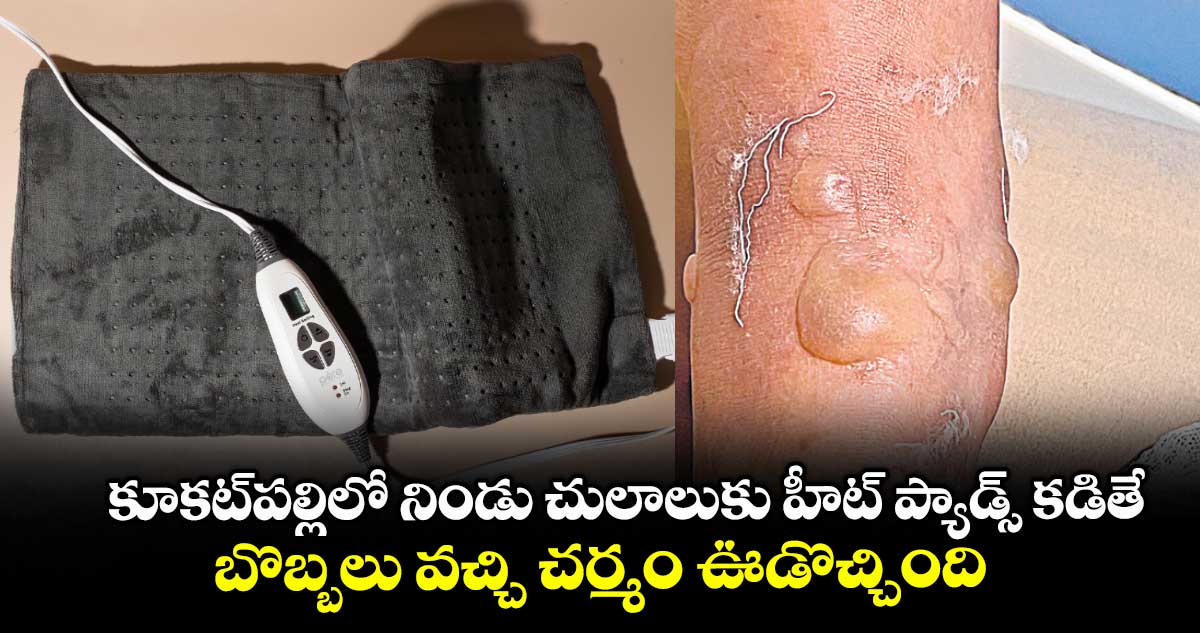 కూకట్పల్లిలో నిండు చులాలుకు హీట్ ప్యాడ్స్ కడితే.. బొబ్బలు వచ్చి చర్మం ఊడొచ్చింది