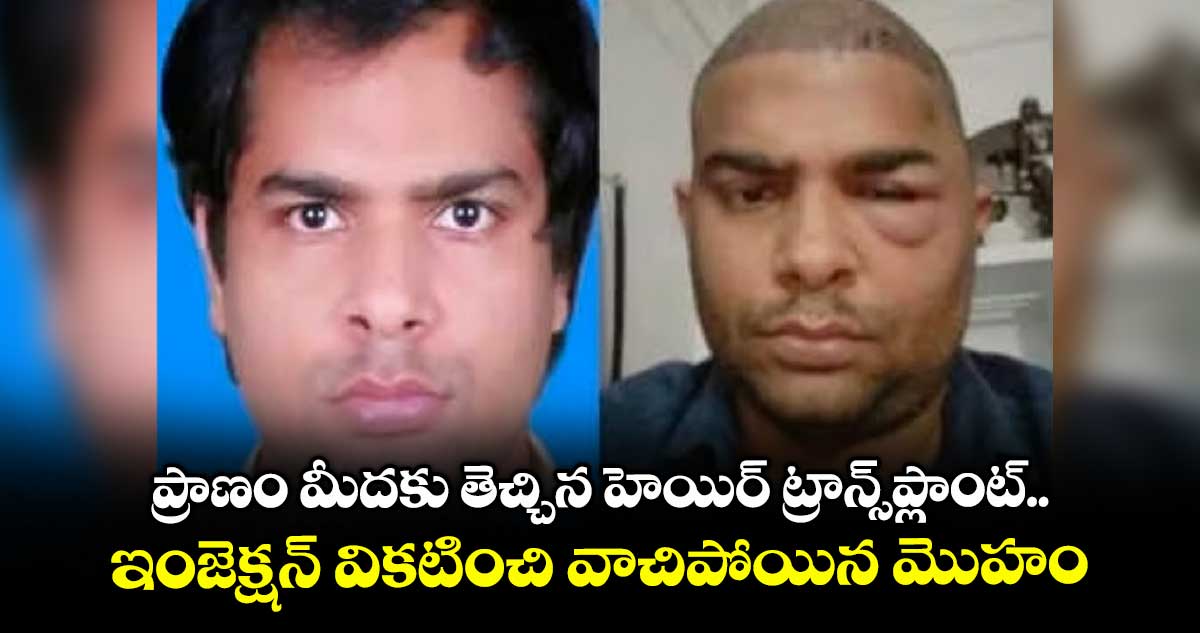 ప్రాణం మీదకు తెచ్చిన హెయిర్ ట్రాన్స్ప్లాంట్..ఇంజెక్షన్ వికటించి వాచిపోయిన మొహం