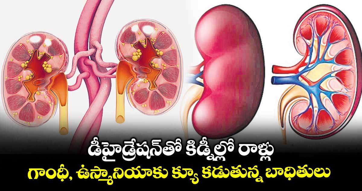 డీహైడ్రేషన్తో కిడ్నీల్లో రాళ్లు.. గాంధీ, ఉస్మానియాకు క్యూ కడుతున్న బాధితులు