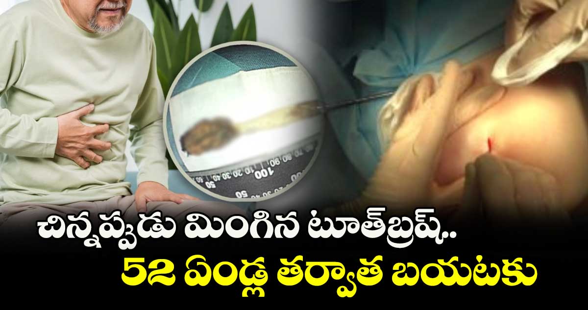 చిన్నప్పుడు మింగిన టూత్బ్రష్.. 52 ఏండ్ల తర్వాత బయటకు