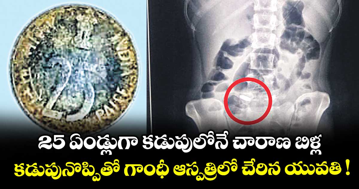 25 ఏండ్లుగా కడుపులోనే చారాణ బిళ్ల.. కడుపునొప్పితో గాంధీ ఆస్పత్రిలో చేరిన యువతి !