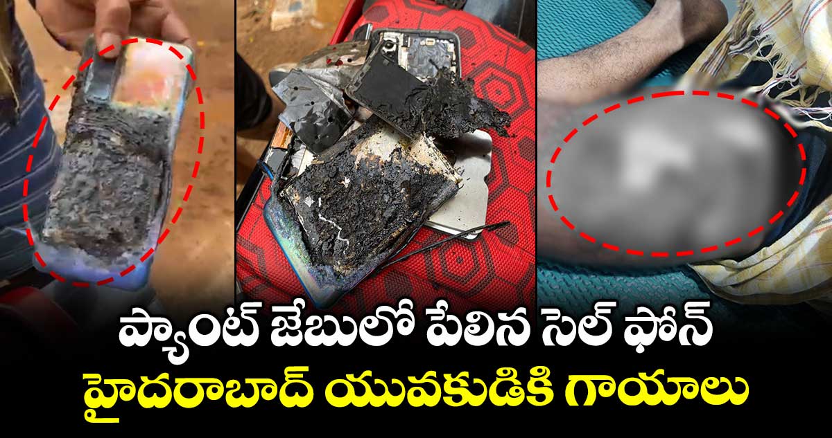 ప్యాంట్ జేబులో పేలిన సెల్ ఫోన్..హైదరాబాద్ యువకుడికి గాయాలు