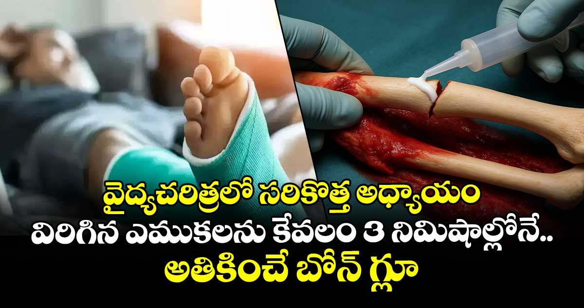 వైద్యచరిత్రలో సరికొత్త అధ్యాయం.. విరిగిన ఎముకలను కేవలం 3నిమిషాల్లోనే అతికించే బోన్ గ్లూ