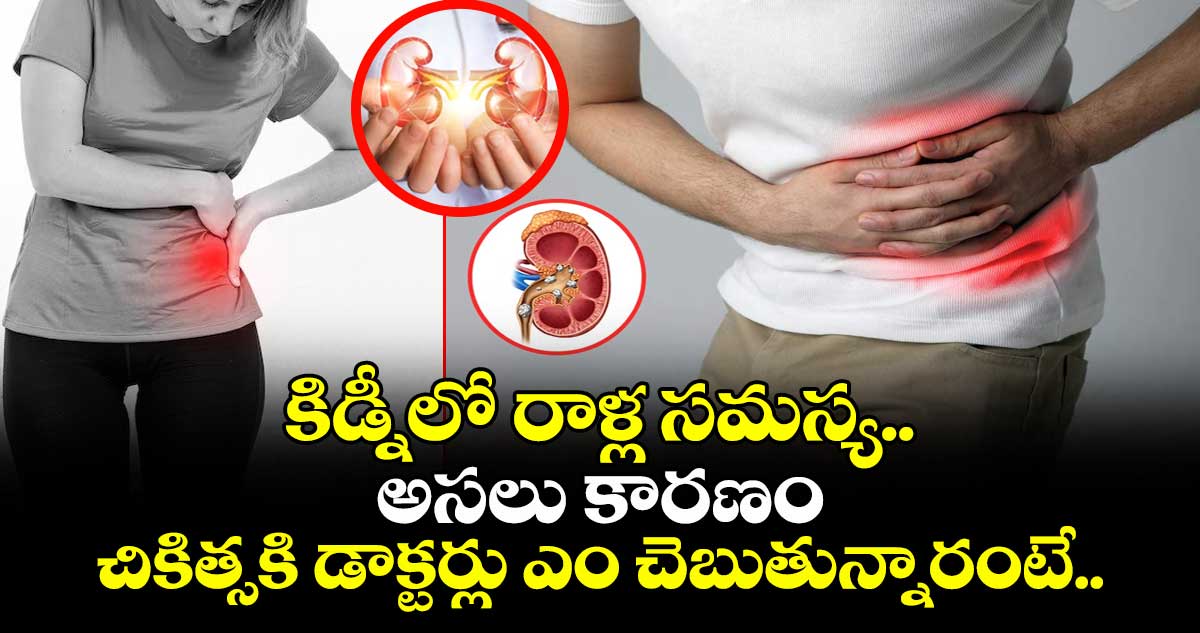  కిడ్నీలో రాళ్ల సమస్య..:  అసలు కారణం, చికిత్సకి డాక్టర్లు ఎం చెబుతున్నారంటే..