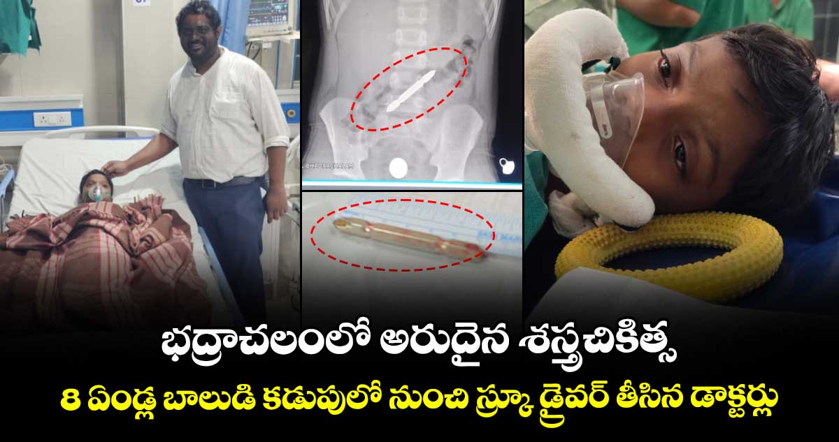 భద్రాచలంలో అరుదైన శస్త్రచికిత్స.. 8 ఏండ్ల బాలుడి కడుపులో నుంచి స్క్రూ డ్రైవర్ తీసిన డాక్టర్లు