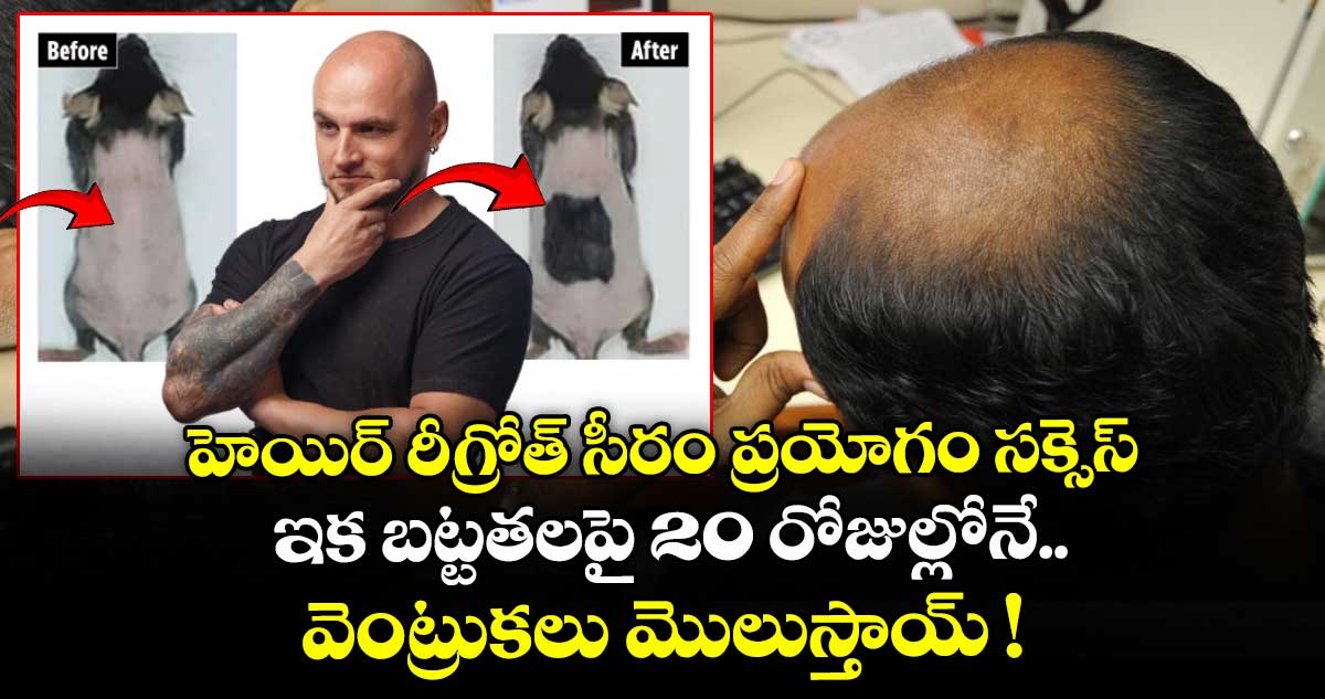 హెయిర్ రీగ్రోత్ సీరం ప్రయోగం సక్సెస్.. ఇక బట్టతలపై 20 రోజుల్లోనే.. వెంట్రుకలు మొలుస్తాయ్ !