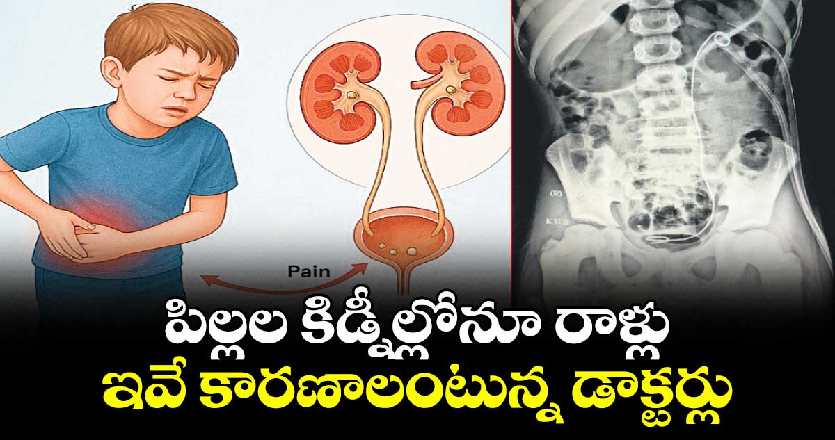 పిల్లల కిడ్నీల్లోనూ రాళ్లు ఇవే కారణాలంటున్న డాక్టర్లు 