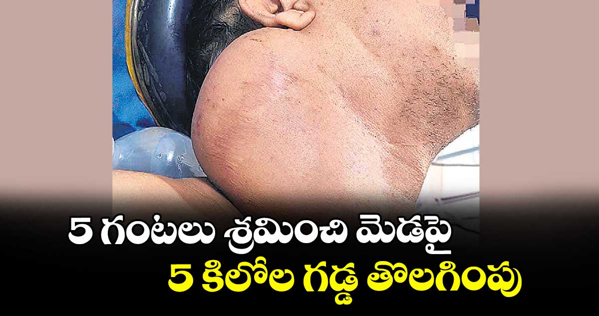 5 గంటలు శ్రమించి మెడపై 5 కిలోల గడ్డ తొలగింపు