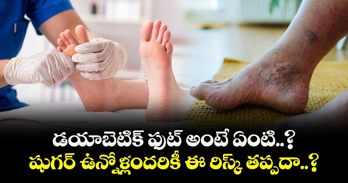 Good Health:  డయాబెటిక్ ఫుట్ అంటే ఏంటి.. ? షుగర్ ఉన్నోళ్లందరికీ ఈ రిస్క్ తప్పదా.. ?