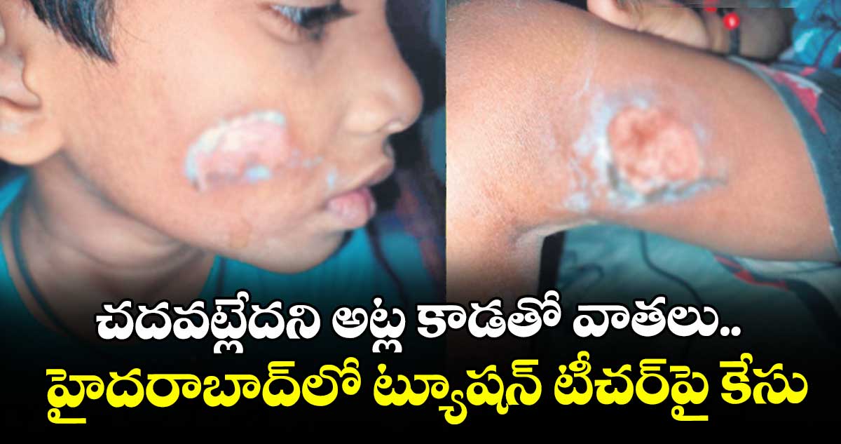 చదవట్లేదని అట్ల కాడతో వాతలు.. హైదరాబాద్⁭లో ట్యూషన్ టీచర్⁭పై కేసు 