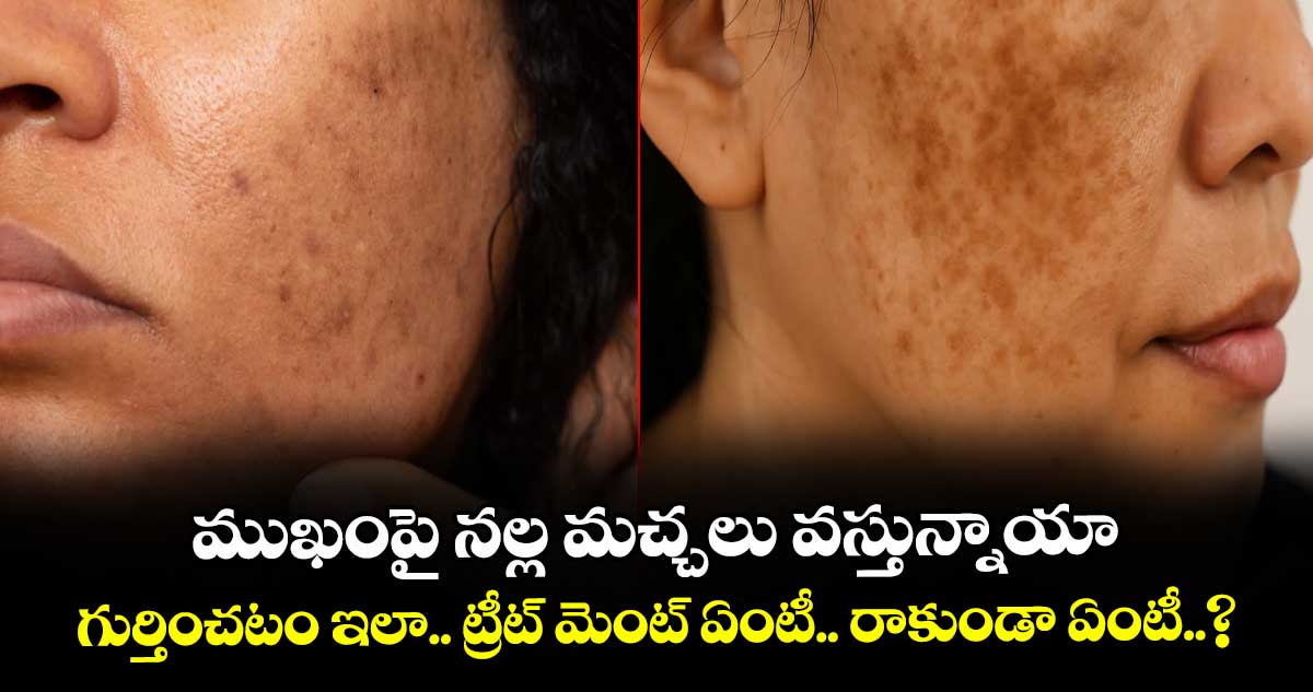 ముఖంపై నల్ల మచ్చలు వస్తున్నాయా.. గుర్తించటం ఇలా.. ట్రీట్ మెంట్ ఏంటీ.. రాకుండా ఏంటీ..?