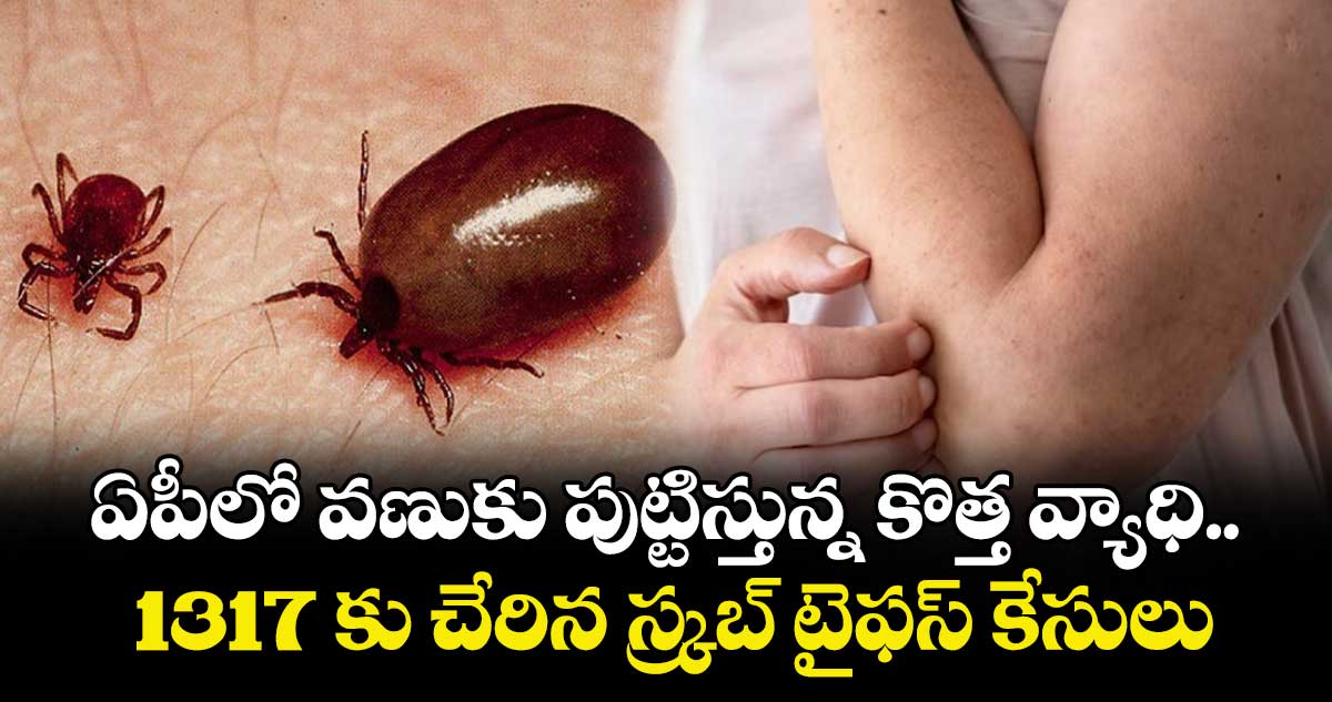 ఏపీలో వణుకు పుట్టిస్తున్న కొత్త వ్యాధి.. 1317 కు చేరిన స్క్రబ్ టైఫస్ కేసులు