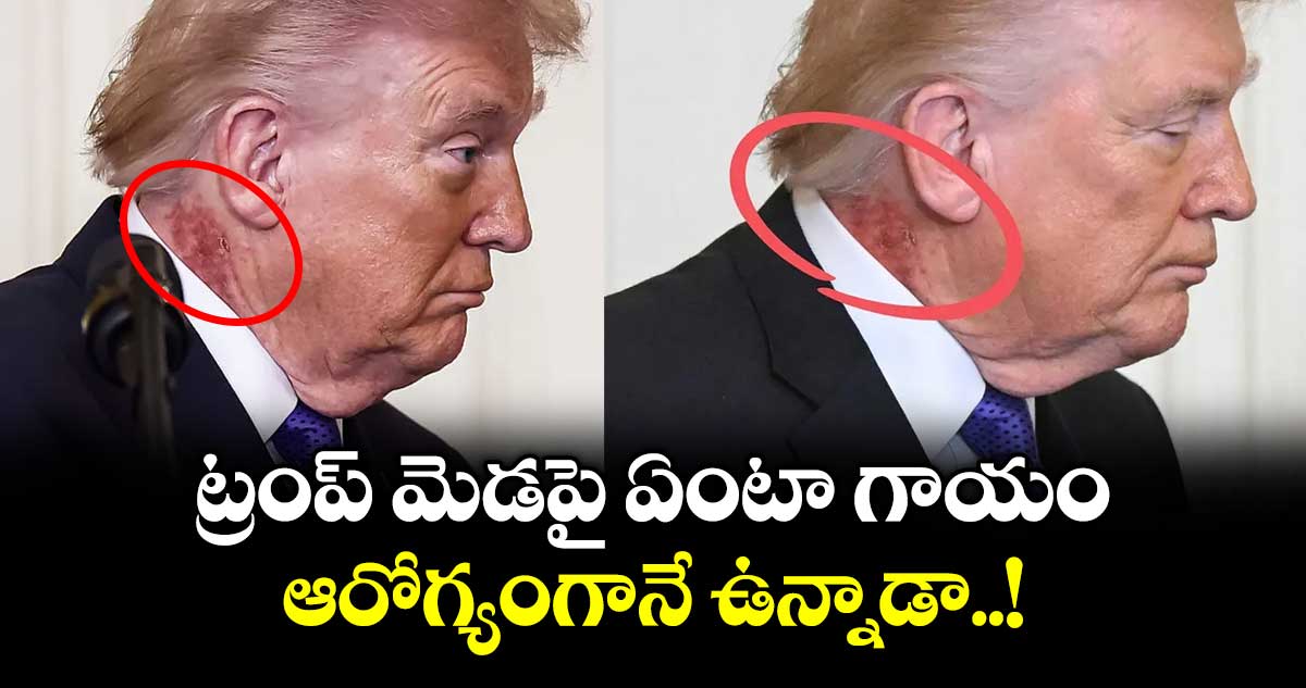 ట్రంప్ మెడపై ఏంటా గాయం.. ఆరోగ్యంగానే ఉన్నాడా..!
