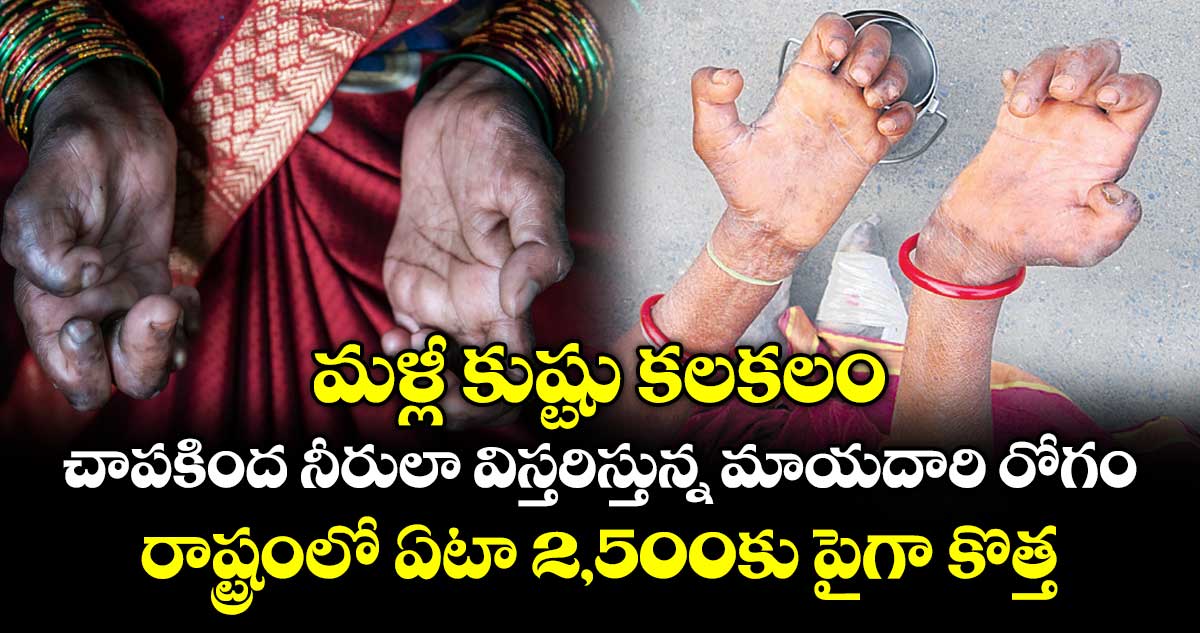 మళ్లీ కుష్టు కలకలం.. చాపకింద నీరులా విస్తరిస్తున్న మాయదారి రోగం.. రాష్ట్రంలో ఏటా 2,500కు పైగా కొత్త కేసులు