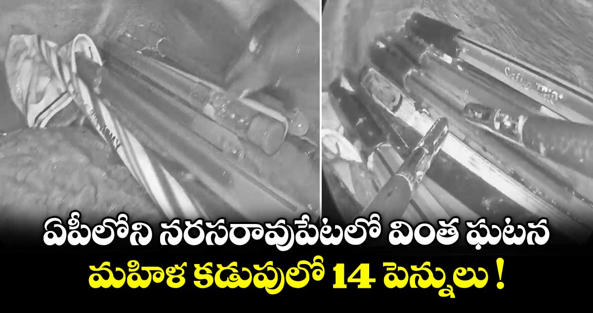ఏపీలోని నరసరావుపేటలో వింత ఘటన.. మహిళ కడుపులో 14 పెన్నులు !