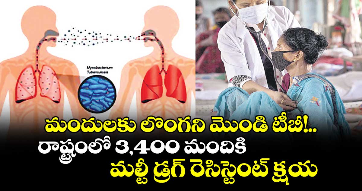 మందులకు లొంగని మొండి టీబీ!..రాష్ట్రంలో 3,400 మందికి మల్టీ డ్రగ్ రెసిస్టెంట్ క్షయ